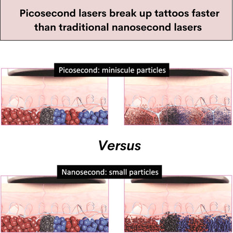 Picosecond Lasers Shatter Tattoo Ink More Powerfully than Traditional Lasers