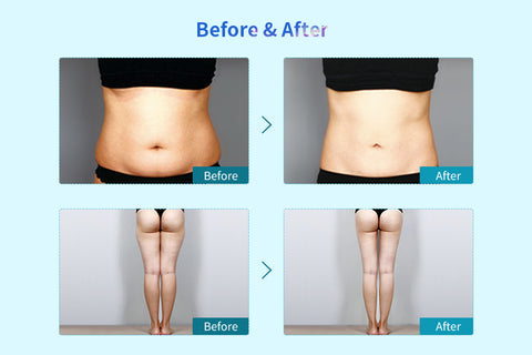 Before and After Cryotherapy Treatment, Stomach and Legs