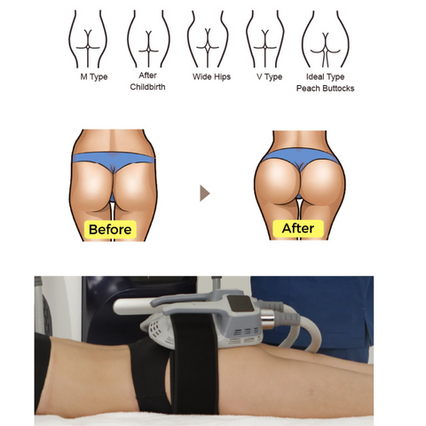 Handles of EMSlim machine are attached to buttocks effecting butt lifting procedure