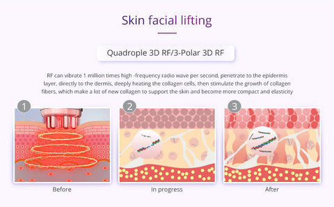 Skin Facial Lifting Before, In Progress, After, Quadruple  RF and 3 Polar RF effects on the skin dermis