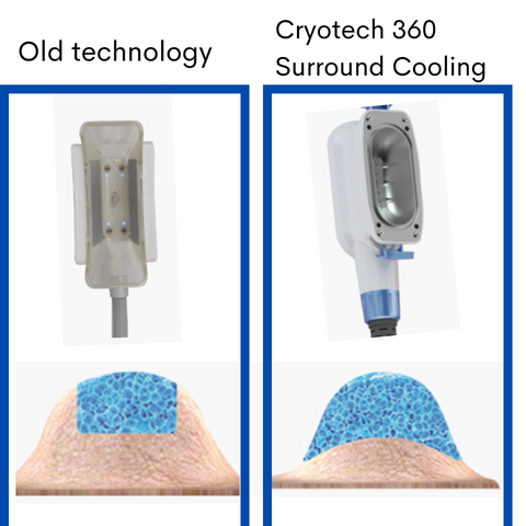 Cryotech 360 Degree Surround Cooling Handle versus Old Technology