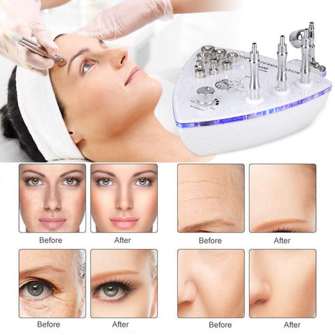 Before and After Effects on Facial Skin of Diamond Microdermabrasion Machine