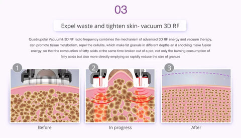 Cavitation Machine Vacuum Expels waste and tightens skin