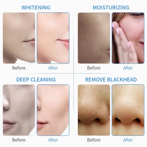 Before and after using hydrafacial machine, whitening, moisturizing, deep cleaning, remove blackheads
