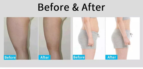 Before and after using Unoisetion Cavitation Machine on Body