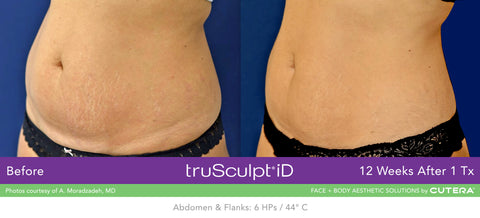 truSculpt iD Before & After