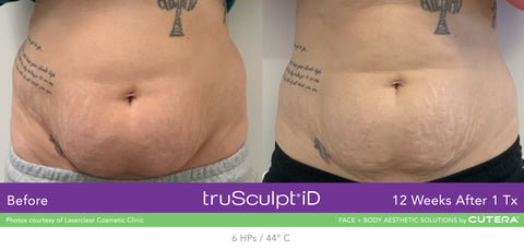 truSculpt iD Before & After