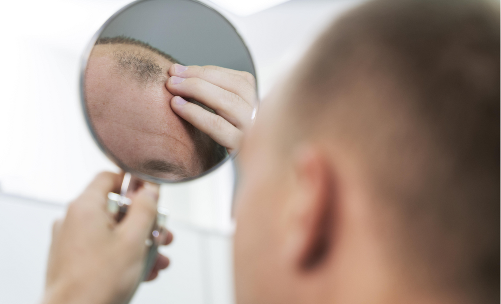 Hair Loss Causes Reasons for Balding  Bernstein Medical