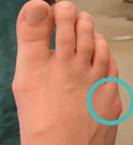 bony lump that forms along the side of the fifth metatarsal bone (little toe).