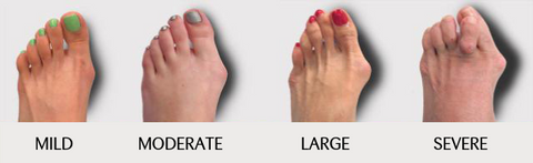 bunion progression stages