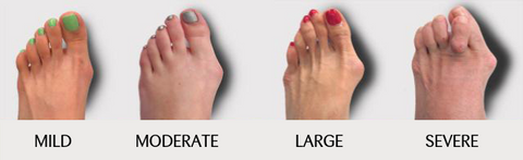 toe-seperator-hallux-valgus-deformity