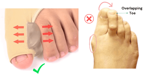 toe realignment, prevents overlapping underlapping big toe
