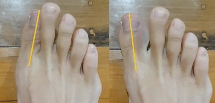 big toe side tap exercise for pain relief & correction