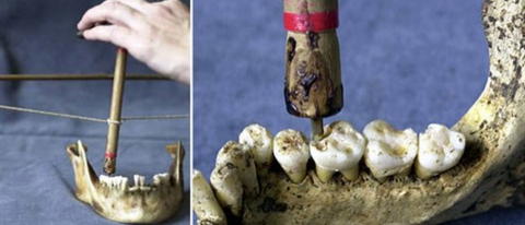 Early dental drill being used on skeleton's teeth