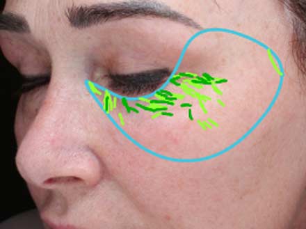 Klotho Skin Improvement in wrinkles by 33% in 90 days