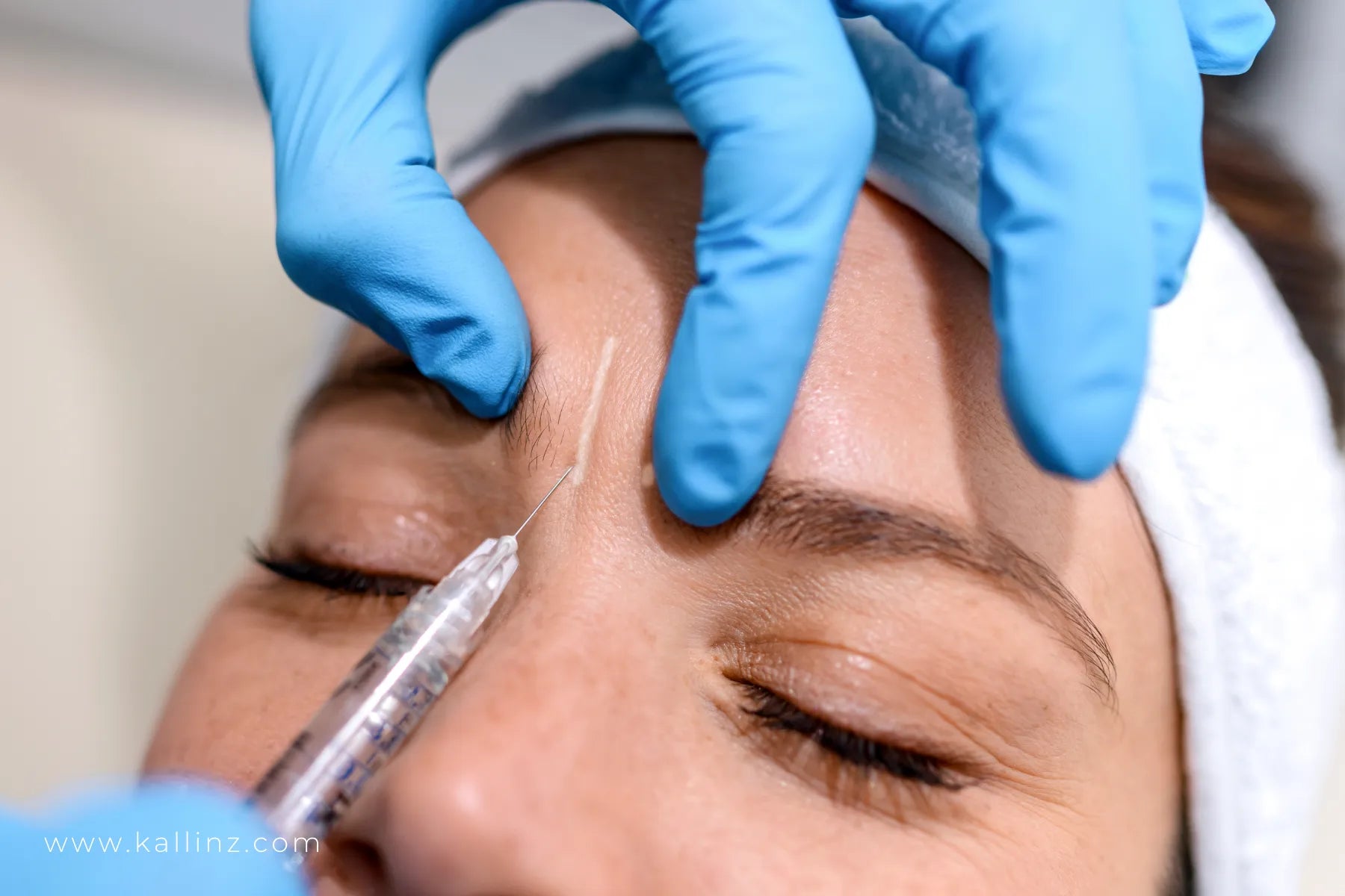 11 lines botox
