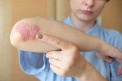 Psoriasis consei len officien