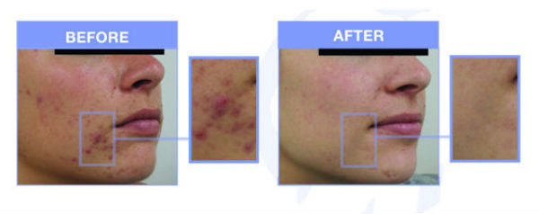 Acne - Before and After