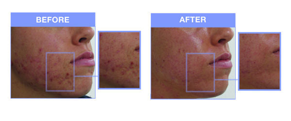 Acne - Before and After