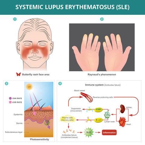 a lupus diagram explaining with multiple graphics