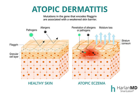 graph of atopic dermatitis