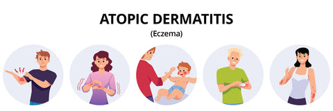 graphic for atopic dermatitis