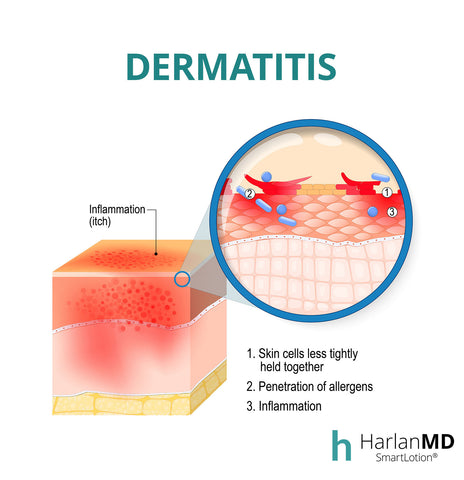 Graphic explaining dermatitis
