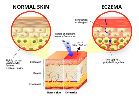 Graphic showing what eczema is