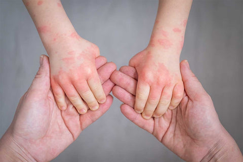 kids and eczema