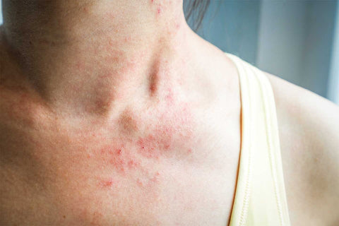 eczema prone skin