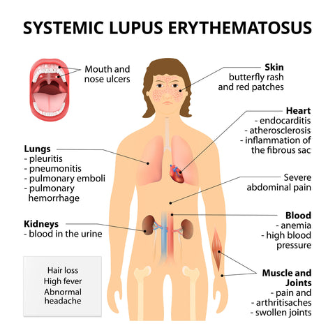 A diagram of lupus
