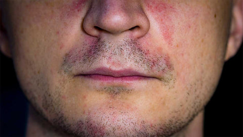 Perioral dermatits example that could be treated with laser