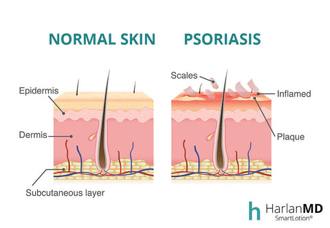 what is psoriasis and can you cut your hair graphic