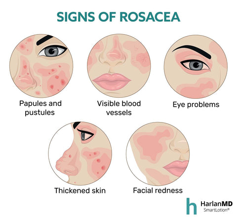 signs of Rocacea infographic