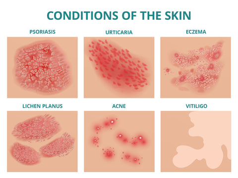 Different eczema conditions