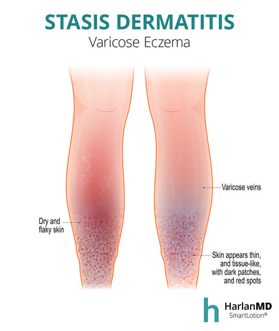 graphic of stasis dermatits