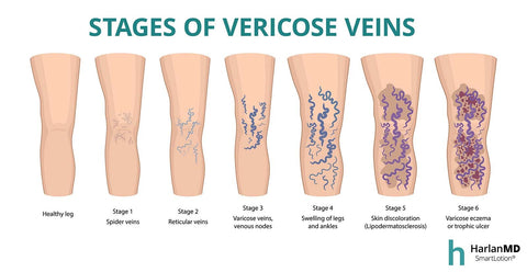 stages of vericose veins