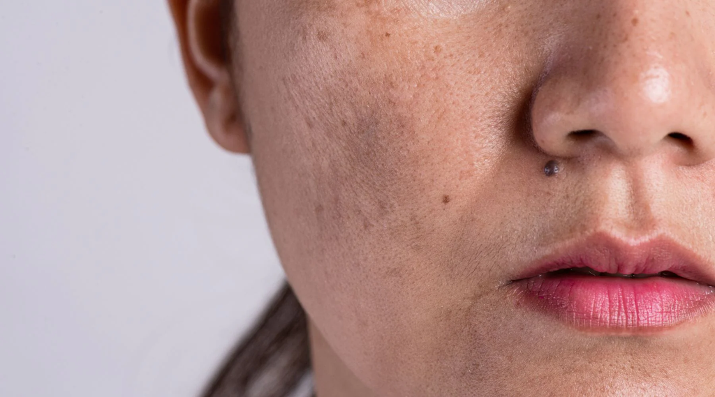 Simple Organic Difference between skin spots