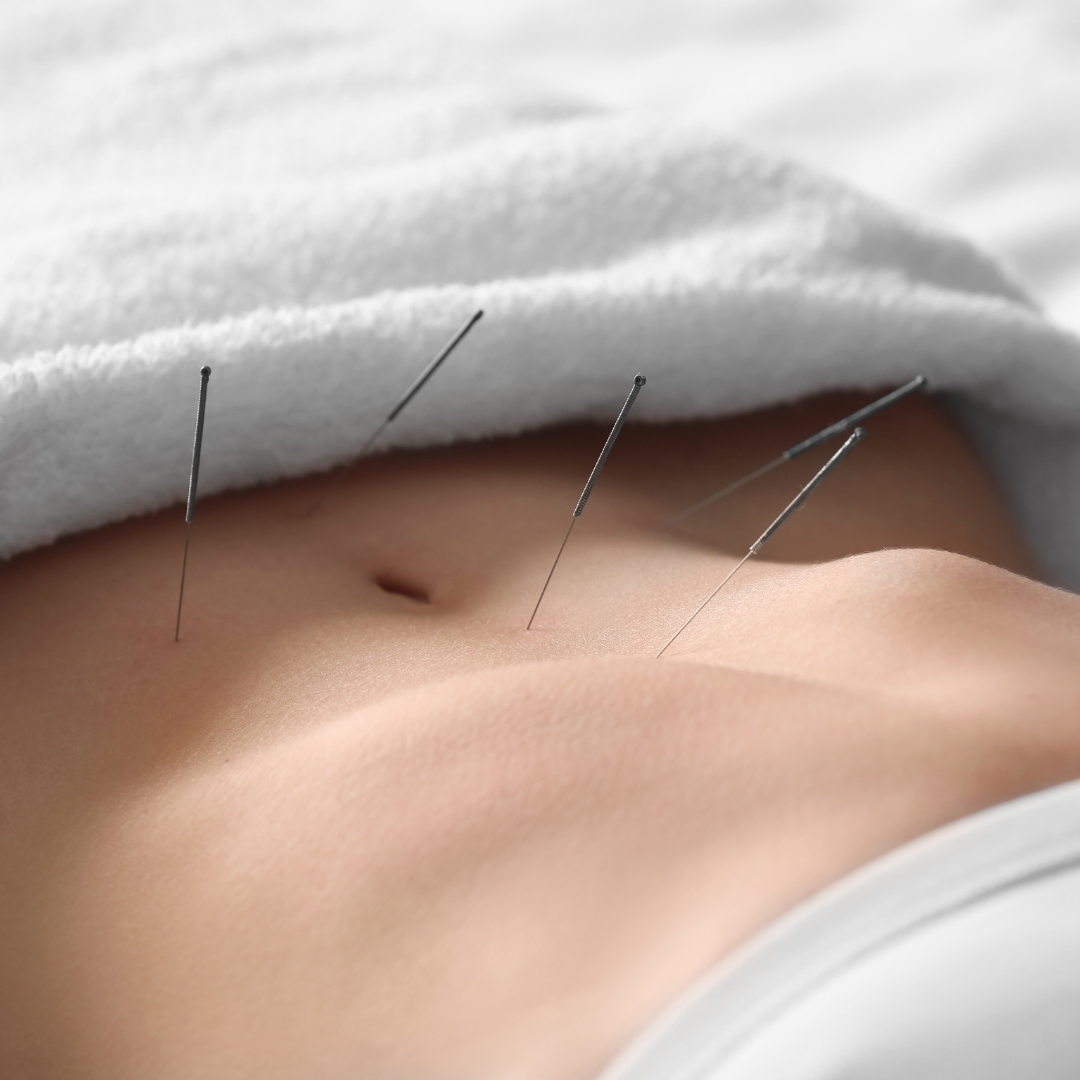 Acupuncture for Pain Management