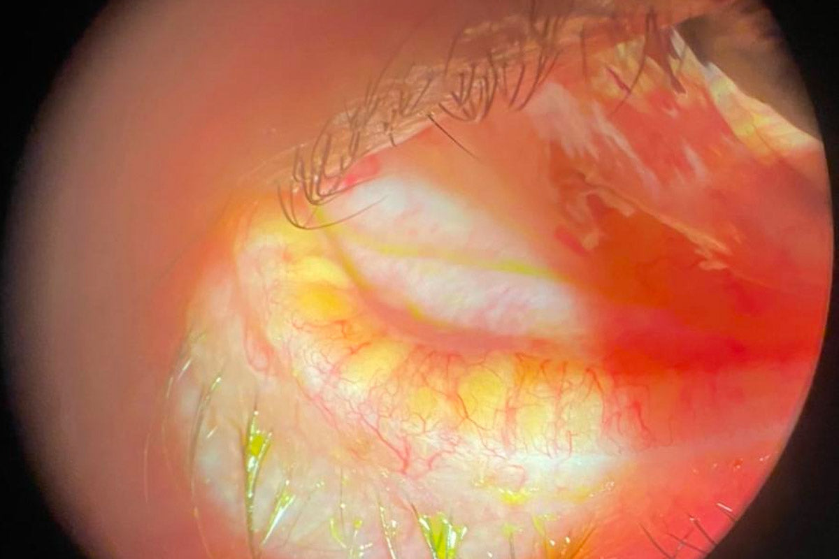 Blefaritis vista con microscopio de oftalmóloga (cortesia dra Vanessa Vidal)