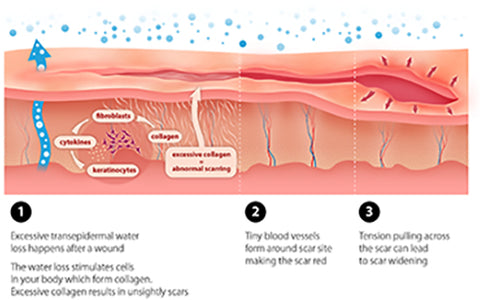 ScarOFF™ Advanced Scar Removal Gel 