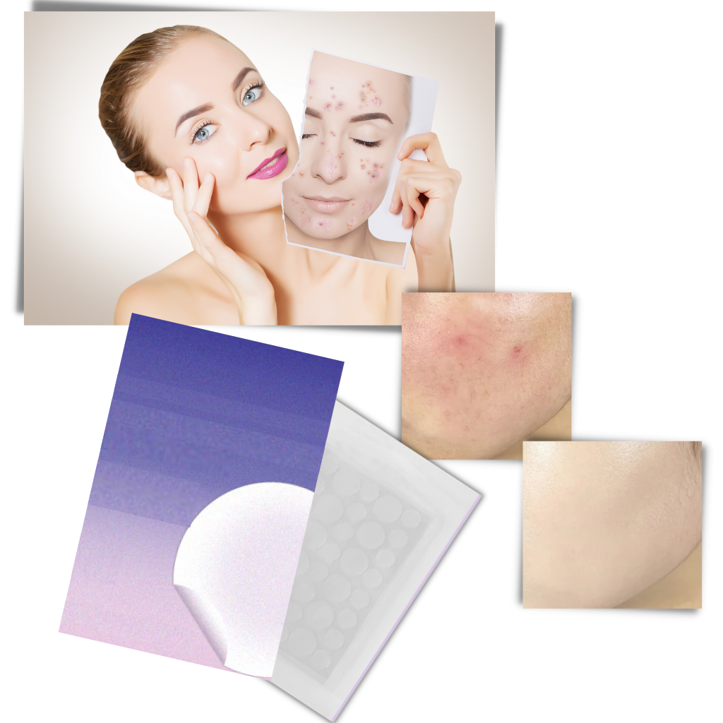 Pack de 36 patchs invisibles contre l'acné - Traitement efficace contre l'acné - Ozerty