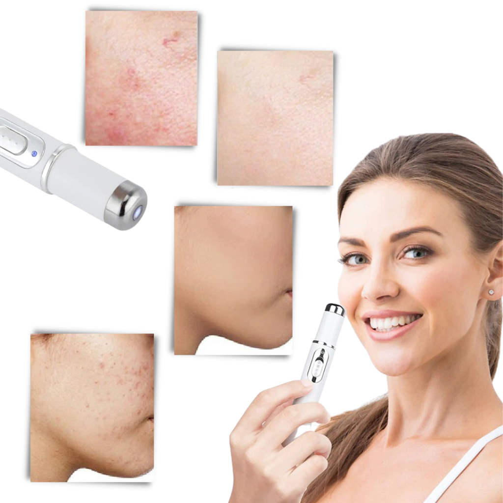Penna per la terapia della pelle a luce blu - Può eliminare l'acne - Ozerty