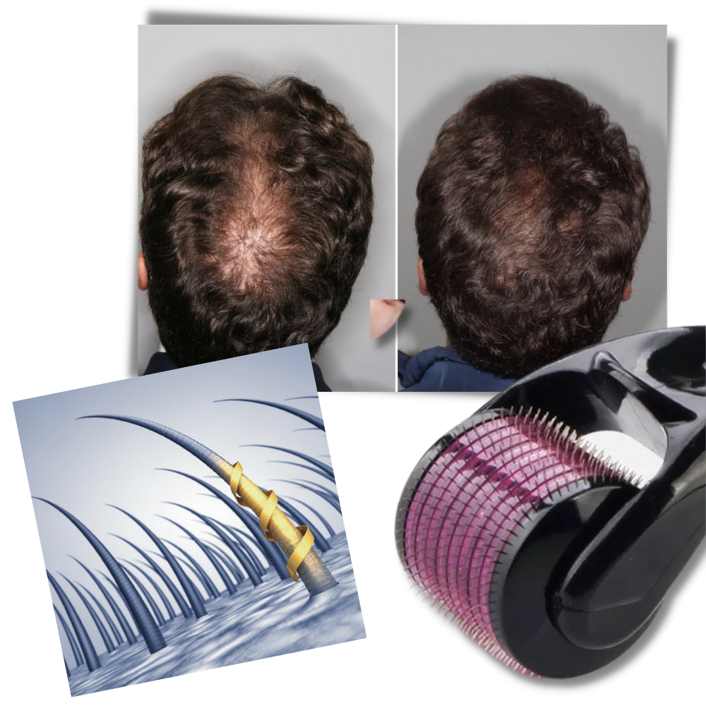 Rouleau dermique pour la croissance des cheveux et de la barbe - 540 micro-aiguilles - Ozerty