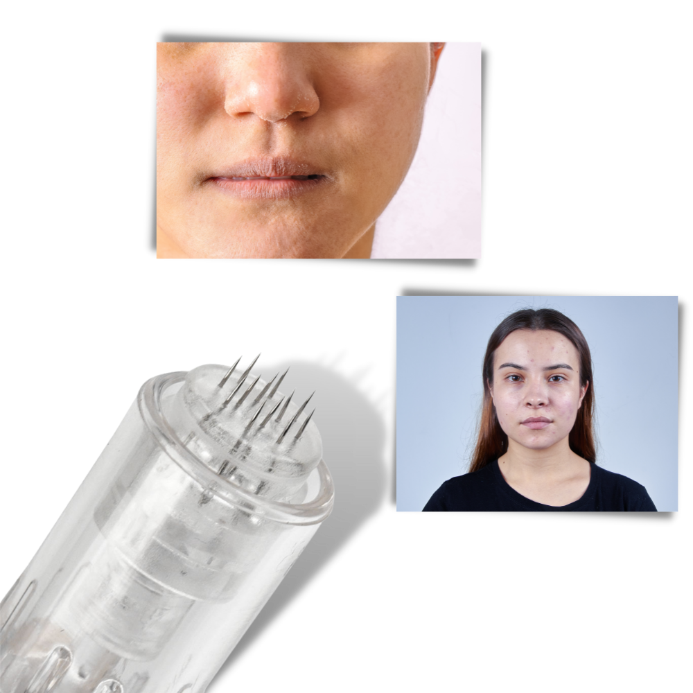 Dermal Microneedling Pen - Suitable for All Types of Skin - 