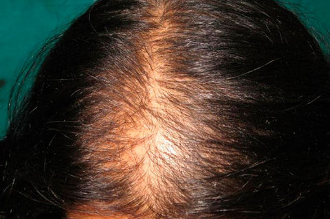 vitaminas para el cabello caida