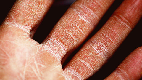 Eczema of the hand