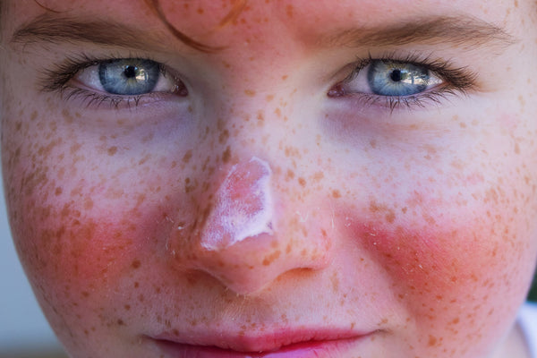 sunlight damage to skin