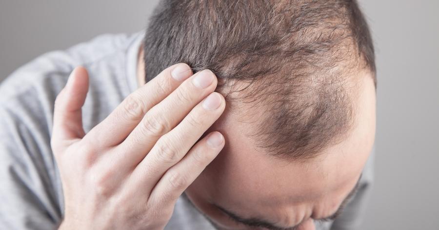 One male hair loss treatment works better than others study finds  CNN