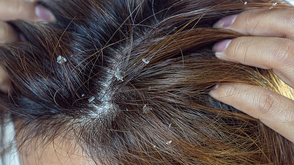 Fungal infection of the scalp